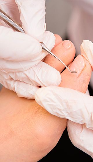 5 Myths About Ingrown Toenails