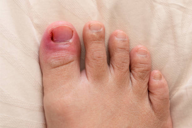 5 Myths About Ingrown Toenails